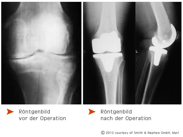 Röntgenbilder vor und nach der Operation - copyright: smith & nephew