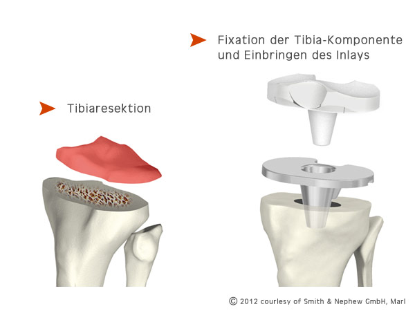 Tibiaresektion und Fixation der Tibia-Komponente - copyright: smith & nephew